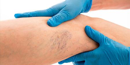 Flebología - Escleroterapia